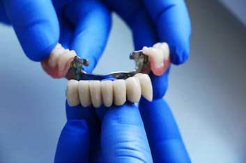 Dental Bridge