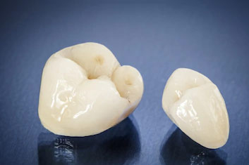 Dental Crowns