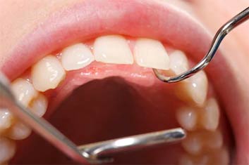 Dental Scaling 